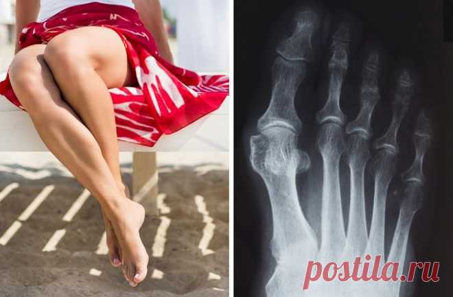 Вальгусная деформация стопы. Причины заболевания, его симптомы и лечение