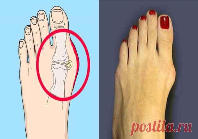 Вот Как в домашних условиях эффективно лечится шишка на ноге …