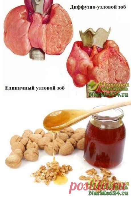 Узловой зоб: классификация, особенности питания, помощь народной медицины