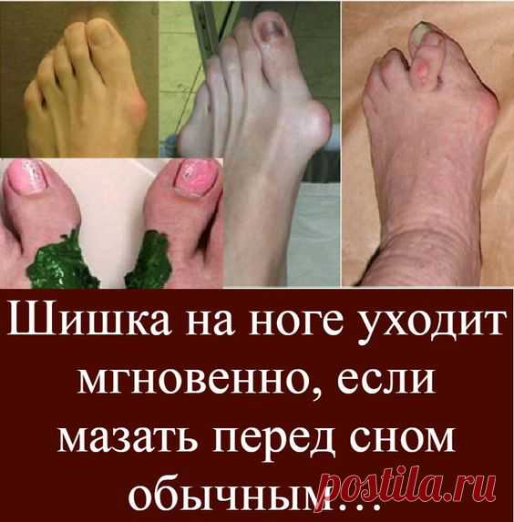Причины вальгусной деформации
«Hallux abducto valgus» или «Вальгусная деформация первого пальца стопы» — медицинский термин, означающий искривление и отклонение плюснефалангового сустава большого пальца кнаружи.

 

При этом первая фаланга большого пальца может смещаться над- или под второй палец, а плюснефаланговый сустав выпирает и образует вальгусную «шишку».