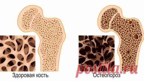 Почему коллаген важнее для костей, чем кальций / Будьте здоровы