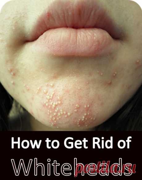 How to Get Rid of Whiteheads | Virtual Clinic