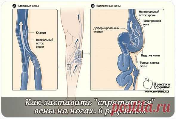 Как заставить ''спрятаться'' вены на ногах. | thePO.ST