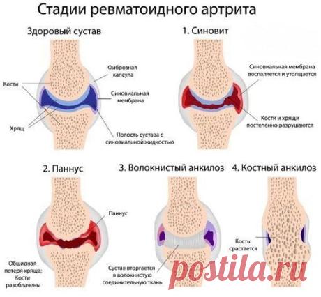 СУПЕРЛЕЧЕНИЕ - КАРТОФЕЛЬ НА КЕФИРЕ ПРОТИВ АРТРИТА

У нас с мамой одна беда на двоих: это артрит. У меня еще и шпоры в придачу. Мы нашли несколько рецептов и решили полечиться настоем картофеля на кефире, нам говорили, что неплохо помогает. Пролечились мы этим рецептом два месяца, но боли нас так и не оставили, и в эффективности этого средства мы сначала даже разочаровались. Но прошло какое-то время мы стали замечать, что артрит перестал нас беспокоить. Оказалось, что излеч...