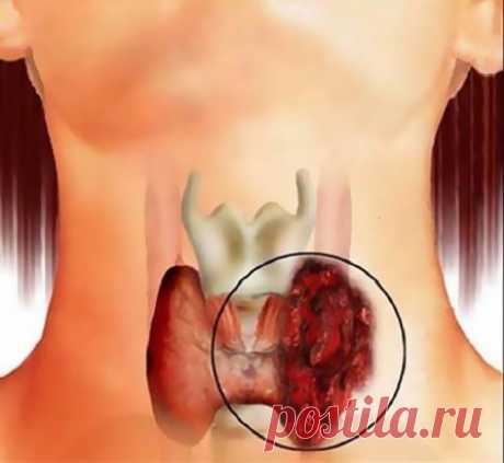 ЛЕЧИМ УЗЕЛ НА ЩИТОВИДНОЙ ЖЕЛЕЗЕ
Смешайте по одному стакану молотой гречневой крупы, пропущенных через мясорубку грецких орехов и меда в эмалированной (абсолютно чистой) посуде и переложите в стеклянную банку. 
Один раз в неделю за целый день съешьте этот состав, не принимая больше никакой пищи, кроме воды. 
Сделайте так шесть раз, т. е. шесть недель. 
Затем через месяц повторите лечение. 
Уже после первого курса зоб уменьшится, а после второго болезнь оставит вас. Проверьтесь на УЗИ: щитовидка