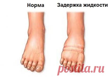 Как справиться с задержкой жидкости в организме? - Шаг к Здоровью