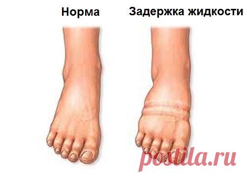 Как справиться с задержкой жидкости в организме? - Шаг к Здоровью