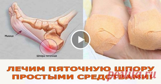 Сейчас Вы Узнаете Как избавиться от Пяточной Шпоры — 8 Рецептов и ВИДЕО — Планета и человек