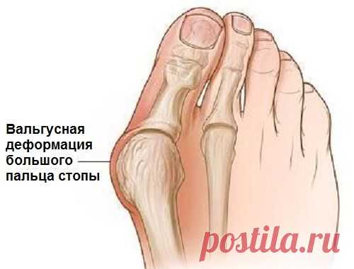 Почему происходит вальгусная деформация стопы? - Шаг к Здоровью