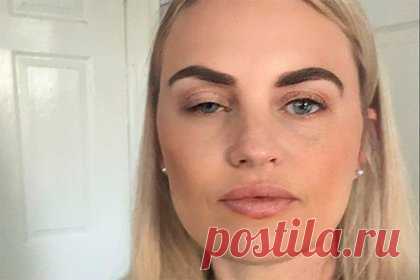 Невеста осталась с глазами разного размера из-за инъекций ботокса перед свадьбой. Невеста Карла Беллуччи из Хитчина, Англия, осталась с глазами разного размера из-за инъекций ботокса перед свадьбой. Незадолго до бракосочетания две клиники предложили британке указанные услуги бесплатно. Отмечается, что клиентка согласилась и сделала подряд четыре процедуры.