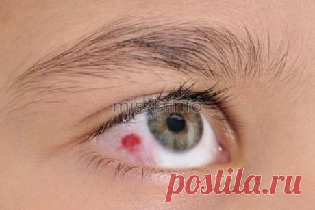 Лопнул сосудик в глазу какие капли закапать? Покраснение глазного яблока - это результат разрыва кровеносного сосуда по причине интенсивных физических нагрузок, повышенного давления, ангиопатии или других заболеваний. Офтальмологические капли помогают убрать кровоизлияние и предотвратить развитие опасных последствий для зрения. Эффективные