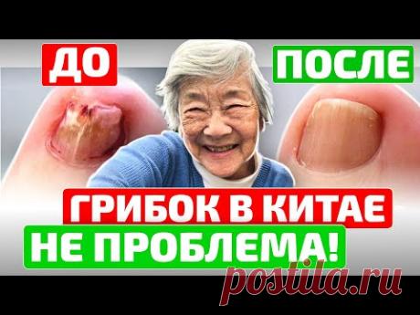 Вот как за 20 мин в китайской народной медицине избавляются от грибка ногтей