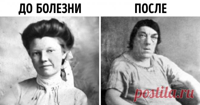 Любящая мать готова ради своих детей на все. Мэри Энн Вебстер (в замужестве — Беван) относится к их числу: она не побоялась стать объектом для насмешек, выставив свою нетипичную внешность на всеобщее обозрение. У нее была цель: во что бы то ни стало прокормить детей. Мэри предстояло пройти через оскорбления, унижения и чудачества зрителей, которые хотели поглазеть на «самую уродливую женщину в мире».