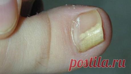 Эффективное 2-компонентное средство от грибка ногтей / Будьте здоровы