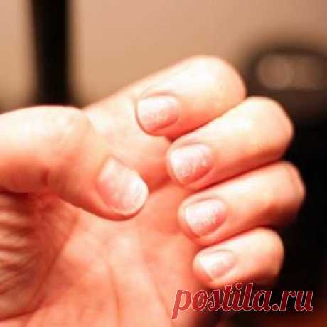 Легкие способы лечения отслаивания ногтей Позаботьтесь о ноготках