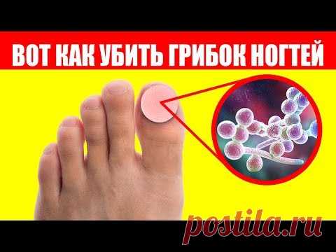 Грибок На Ногах. 90% людей не знают этих ошибок при лечении