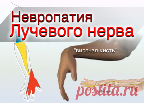 doclvs.ru | Невропатия лучевого нерва: причины, симптомы, диагностика, лечение