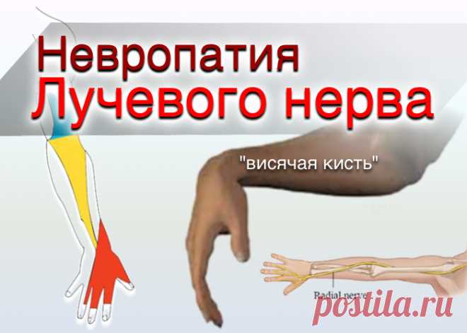 doclvs.ru | Невропатия лучевого нерва: причины, симптомы, диагностика, лечение