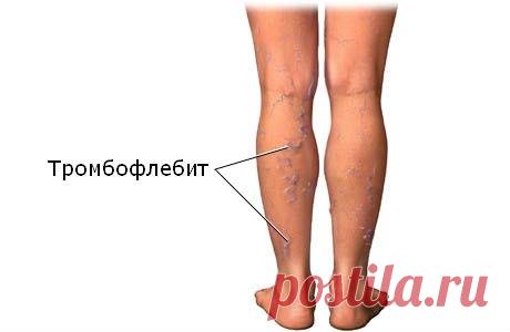 ТРОМБОФЛЕБИТ. ЛЕЧЕНИЕ НАРОДНЫМИ СРЕДСТВАМИ

10 г цветков или плодов каштана конского размельчить и настаивать на 100 мл водки в темноте в течение 7 дней, регулярно взбалтывая. 

Потом настой процедить и принимать по 30 капель в день перед едой.
Показать полностью…