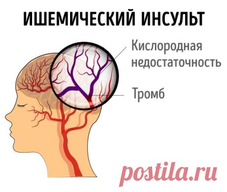 7 СИМПТОМОВ, КОТОРЫЕ ПОМОГУТ РАСПОЗНАТЬ ИНСУЛЬТ У ЖЕНЩИН
Инсульт может случиться с человеком практически в любом возрасте. По статистике, женщины в возрасте от 18 до 40 лет чаще подвержены инсультам, чем мужчины того же возраста.
Расскажем вам о симптом…