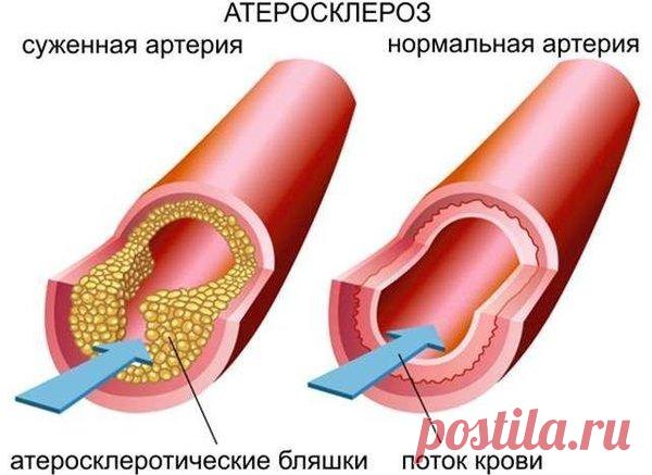 Другой взгляд на причины возникновения атеросклероза. Ч.2 | Здоровье от природы | Яндекс Дзен