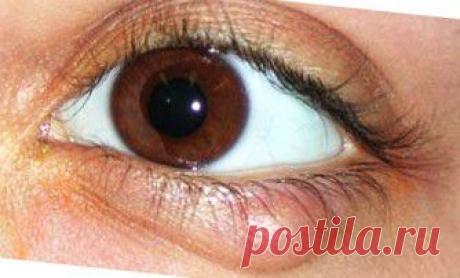 Лечение ячменя на глазу народными средствами | vita-jizn.net
Лечение ячменя на глазу должен проводить врач. Но если доступа к врачу по какой-то причине нет, Вам помогут эти 16 народных рецептов лечения ячменя в глазу
Кроме этого они будут очень неплохим подспорьем к медикаментозному лечению, так как народная мудрость накоплена веками лекарской практики...