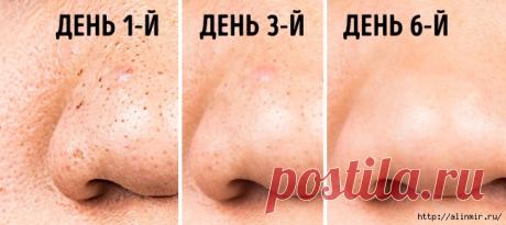 Масло чайного дерева для чистой кожи
