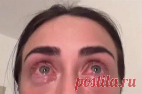 Девушка впервые нарастила ресницы в салоне красоты и попала в больницу. Пользовательница сети Джем (фамилия неизвестна) с никнеймом gembethan впервые нарастила ресницы в салоне красоты и попала в больницу. Девушка решилась на данное преображение за день до вылета на Ибицу, где собиралась отдохнуть. При этом на утро после процедуры она проснулась с покрасневшими глазами.