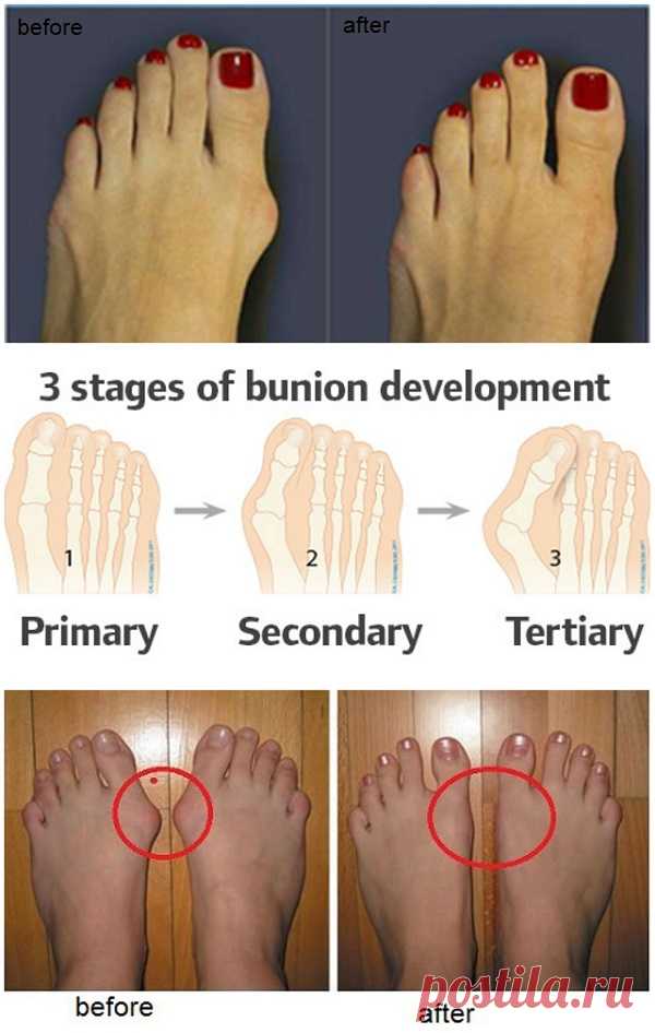 How to Prevent and Treat Bunions - AllDayChic A bunion is a deformity of the great toe characterized by a lateral deviation of it. People usually confuse it with bone growth, but it’s not that, it’s the bones that from wrong shoes or any abnormal pressure applied on the big side of the toe force them to get out from their normal position. …