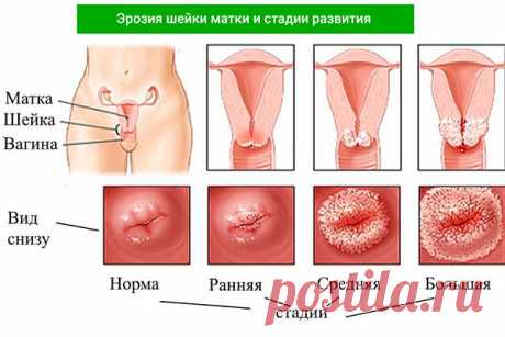 Лечение эрозии шейки матки у нерожавших: методы