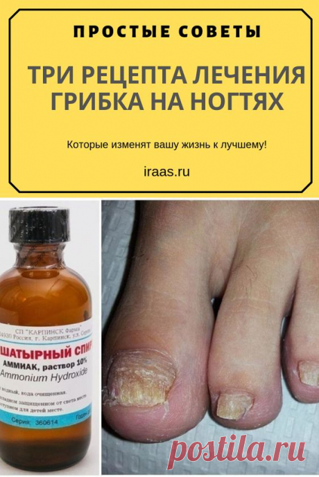 ТРИ РЕЦЕПТА ЛЕЧЕНИЯ ГРИБКА НА НОГТЯХ