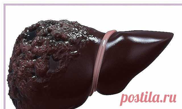 Очень простой и дешёвый способ восстановить печень. Рецепт проверен на больных циррозом печени, даже осложнённым водянкой.