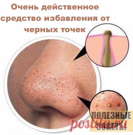 Долой изжогу!

Хочу поделиться рецептом, который помог мне избавиться от изжоги навсегда!

Заливала 1 ст.л. травы чернобыльника (полынь обыкновенная) 200 мл кипятка, ставила на огонь и кипятила в течении 6-7 минут. Затем остужала и процеживала. Пила по 100 мл утром натощак. После чего через 10 минут выпивала 0,5 ст. отвара аптечной ромашки, приготовленного точно также, как отвар полыни.

Если вы не поленитесь и проведете, не прерываясь 12-дневный курс лечения, то наградой ...