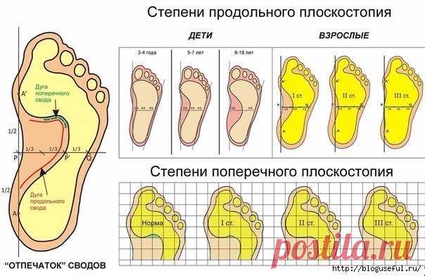 Специальные упражнения, которые помогут избавиться от плоскостопия