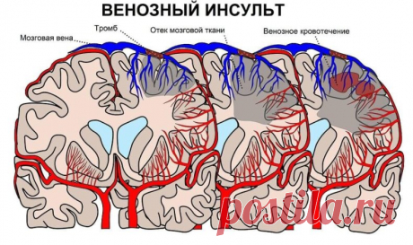 **Венозный застой головного мозга: Народные Рецепты и Способы Применения** 

Когда дело касается здоровья, природа может предложить удивительные решения. Если вы столкнулись с венозным застоем головного мозга, не спешите к химическим препаратам - природа может помочь. Ведь растения обладают уникальными свойствами, которые способны поддержать ваше здоровье.

 **Преимущества целебных растений:**
Основное преимущество растений - универсальность. Содержание многочисленных акти...