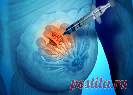 Пункция молочной железы: показания, подготовка, виды