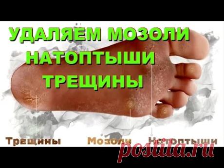 УДАЛЯЕМ МОЗОЛИ, НАТОПТЫШИ, ТРЕЩИНЫ