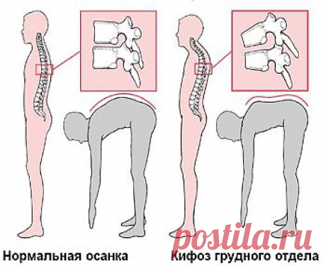 Традиционные методы лечения кифоза | 

Лечение кифоза позвоночника – это терапевтическая методика, которая позволяет предотвратить развитее заболевания, снизить деформацию позвоночника и его дальнейшее искривление, а также уменьшить риск возникновения осложнений со стороны дыхательной, сердечно-сосудистой системы и органов пищеварения.

Также благодаря лечению снижаются болезненные ощущения в спине, и повышается качество жизни пациента.