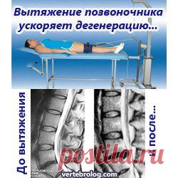 Вытяжение позвоночника провоцирует грыжеобразование