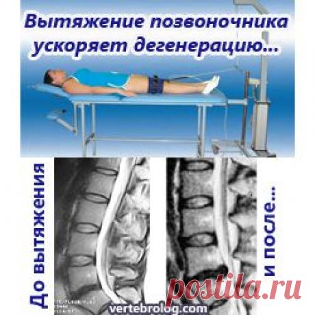 Вытяжение позвоночника провоцирует грыжеобразование