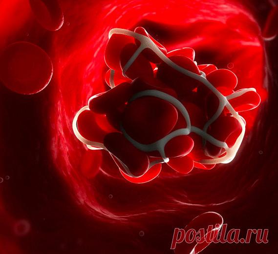 Это НЕОБХОДИМО знать — профилактика образования тромбов