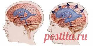 Гидроцефалия: как лечить, рекомендации врача невролога | Врач травматолог-ортопед, онлайн, консультации бесплатно