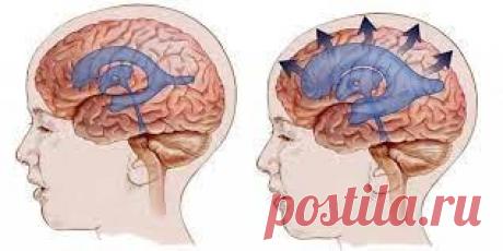 Гидроцефалия: как лечить, рекомендации врача невролога | Врач травматолог-ортопед, онлайн, консультации бесплатно