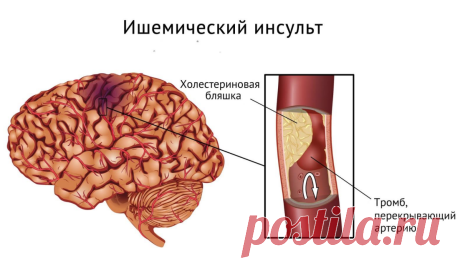Что приводит к развитию инсульта? Поговорим о факторах риска и способах их коррекции | Людям о людях | Яндекс Дзен