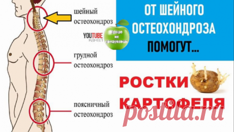 От Остеохондроза шейного отдела позвоночника помогут Картофельные ростки.
Картофельные ростки содержат много активного ядовитого алкалоида соланина, защищающего прорастающие клубни от насекомых и вредителей, губительно действующего на вирусы, грибки и болезнетворные бактерии. Картофельные ростки лечебные свойства имеют благодаря содержанию именно этого вещества. 
Соланин придает препаратам из ростков картошки обезболивающие, противовоспалительные, спазмолитические, антиалл...