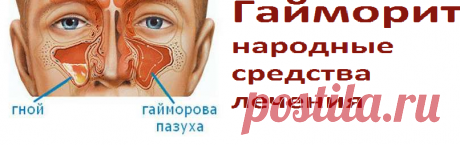 Гайморит, народные средства лечения | Советы целительницы