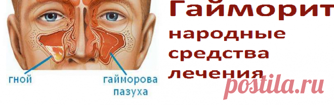 Гайморит, народные средства лечения | Советы целительницы