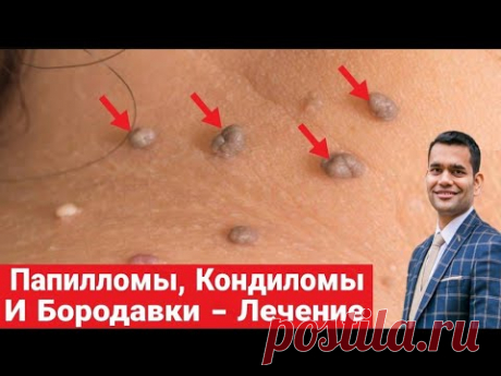 Папилломы, Кондиломы И Бородавки. Внутренние Причины И Домашнее Лечение