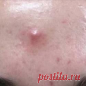 Эти таблетки есть в каждой аптечке и они отлично помогают от прыщей перхоти и мозолей.