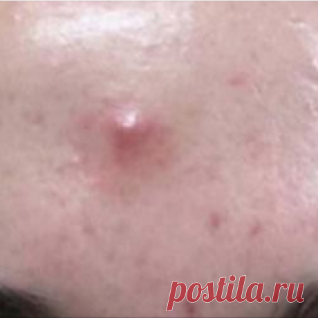 Эти таблетки есть в каждой аптечке и они отлично помогают от прыщей перхоти и мозолей.